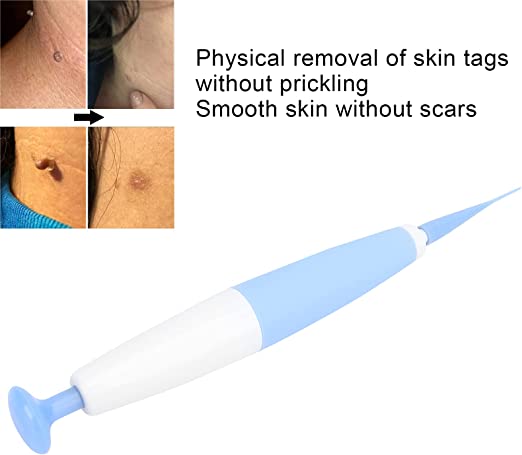 Skin Tag Removal Kit™ - odelly.nl