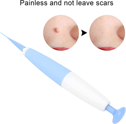 Skin Tag Removal Kit™ - odelly.nl