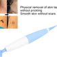 Skin Tag Removal Kit™ - odelly.nl
